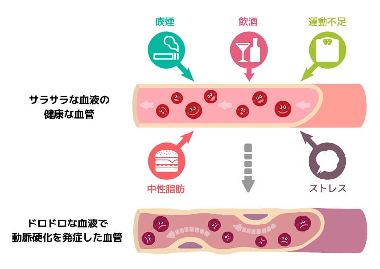 高脂血症（脂質異常症）と動脈硬化との関係性